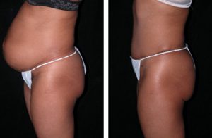 Best Tummy Tuck in Arizona