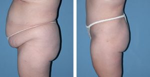 Best Tummy Tuck Surgeon in Scottsdale