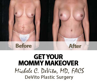 Get Your Mommy Makeover with Dr. Devito