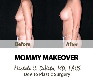 Mommy Makeovers in Paradise Valley, Phoenix, and Scottsdale Arizona