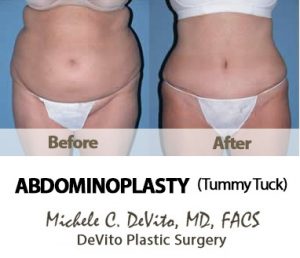Best Tummy Tuck in Phoenix  Abdominoplasty Surgery Scottsdale