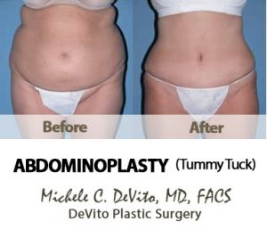 Before Tummy Tuck in Scottsdale