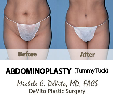 What to expect after an Abdominoplasty