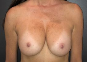 Breast Implant Removal Before Photo