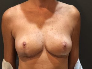 Breast Implant Removal Before And After Photo