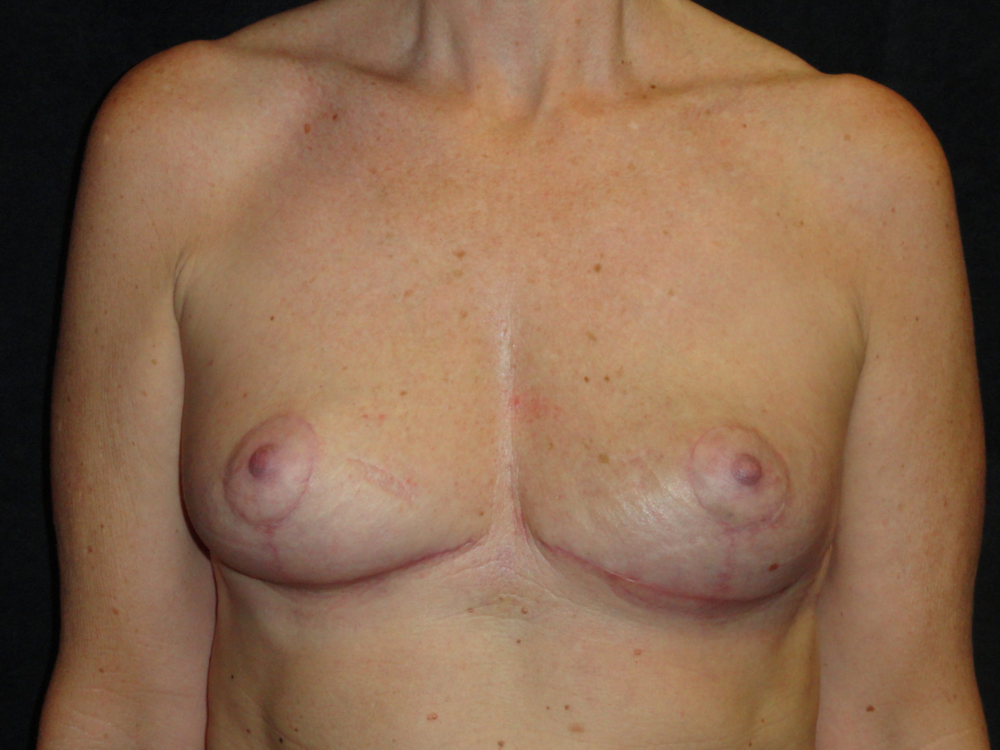 Breast Implant Removal Before And After Photo