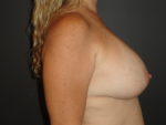 Breast Implant Removal Before And After Photo