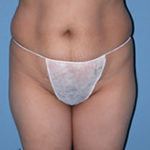 Abdominoplasty Surgical Procedure Case 1 Before Photos