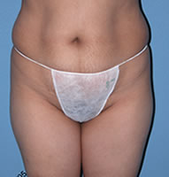 Abdominoplasty Surgical Procedure Case 1 Before Photos