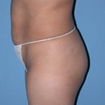 Abdominoplasty Surgical Procedure Case 1 Before Photos