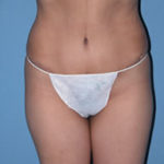 Abdominoplasty Surgical Procedure Case 1 After Photos