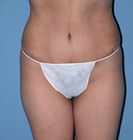 Abdominoplasty Surgical Procedure Case 1 After Photos