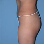 Abdominoplasty Surgical Procedure Case 1 After Photos