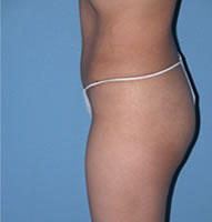 Abdominoplasty Surgical Procedure Case 1 After Photos