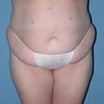 Abdominoplasty in Phoenix Before Photos Case 2