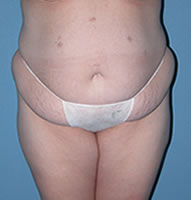 Abdominoplasty in Phoenix Before Photos Case 2