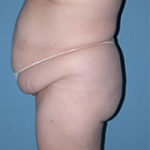 Abdominoplasty in Phoenix Before Photos Case 2