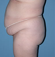 Abdominoplasty in Phoenix Before Photos Case 2