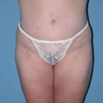 Abdominoplasty in Phoenix After Photos Case 2