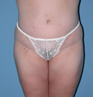 Abdominoplasty in Phoenix After Photos Case 2