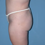 Abdominoplasty in Phoenix After Photos Case 2