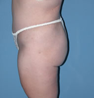 Abdominoplasty in Phoenix After Photos Case 2