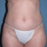 Tummy Tuck Before Photos Case 3