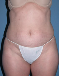 Tummy Tuck Before Photos Case 3