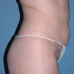 Tummy Tuck Before Photos Case 3