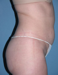 Tummy Tuck Before Photos Case 3