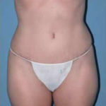 Tummy Tuck After Photos Case 3