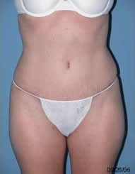 Tummy Tuck After Photos Case 3