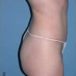 Tummy Tuck After Photos Case 3