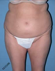 Abdominoplasty Scottsdale Arizona Before Photos Case 4