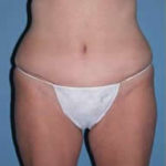Abdominoplasty Scottsdale Arizona After Photos Case 4