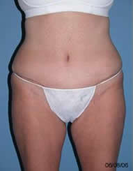 Abdominoplasty Scottsdale Arizona After Photos Case 4