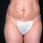 Abdominoplasty Phoenix Arizona Before Photos Case 6