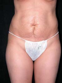 Abdominoplasty Phoenix Arizona Before Photos Case 6