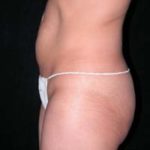 Abdominoplasty Phoenix Arizona Before Photos Case 6