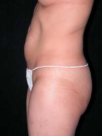 Abdominoplasty Phoenix Arizona Before Photos Case 6