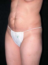 Abdominoplasty Phoenix Arizona Before Photos Case 6