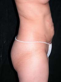 Abdominoplasty Phoenix Arizona Before Photos Case 6