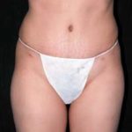 Abdominoplasty Phoenix Arizona After Photos Case 6