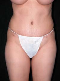 Abdominoplasty Phoenix Arizona After Photos Case 6