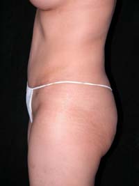 Abdominoplasty Phoenix Arizona After Photos Case 6