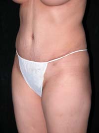 Abdominoplasty Phoenix Arizona After Photos Case 6