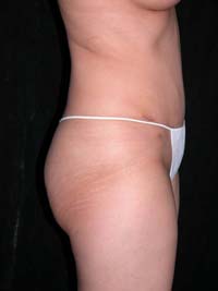 Abdominoplasty Phoenix Arizona After Photos Case 6