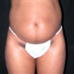 Scottsdale Arizona Abdominoplasty Case 8 Before Photos