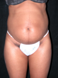 Scottsdale Arizona Abdominoplasty Case 8 Before Photos