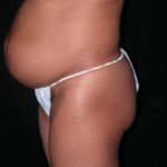 Scottsdale Arizona Abdominoplasty Case 8 Before Photos